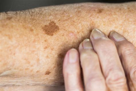 melanoma sun spots on skin